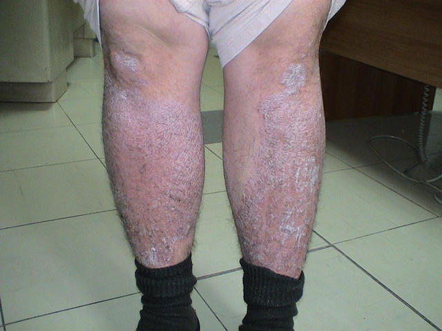 Psoriasis Plaque Psoriasis Picture Hellenic Dermatological Atlas