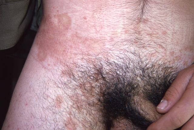 VARIOUS or of UNKNOWN ETIOLOGY DISEASES - Pityriasis rosea