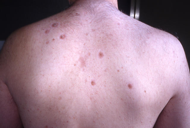 BULLOUS DISEASES - Pemphigus erythematosus