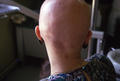 HAIR DISEASES - Alopecia Areata