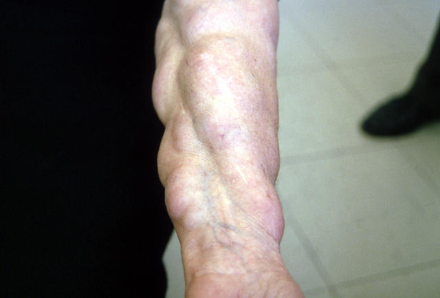 VARIOUS or of UNKNOWN ETIOLOGY DISEASES - Lipomas VARIOUS or of UNKNOWN ETIOLOGY DISEASES - Lipomas