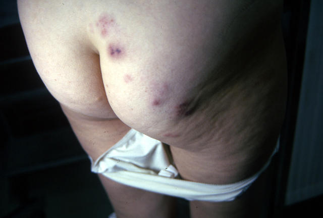 VIRAL INFECTIONS - Herpes Zoster VIRAL INFECTIONS - Herpes Zoster