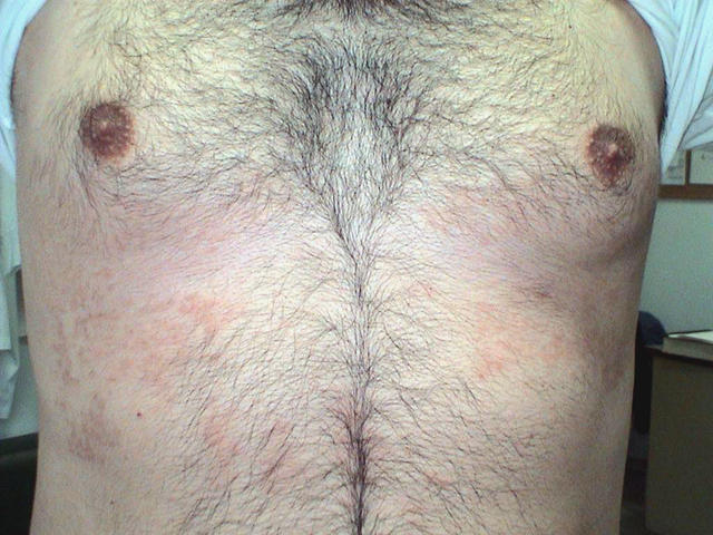 LYMPHOMAS - LYMPHOCYTIC INFILTRATIONS - Mycosis Fungoides LYMPHOMAS - LYMPHOCYTIC INFILTRATIONS - Mycosis Fungoides