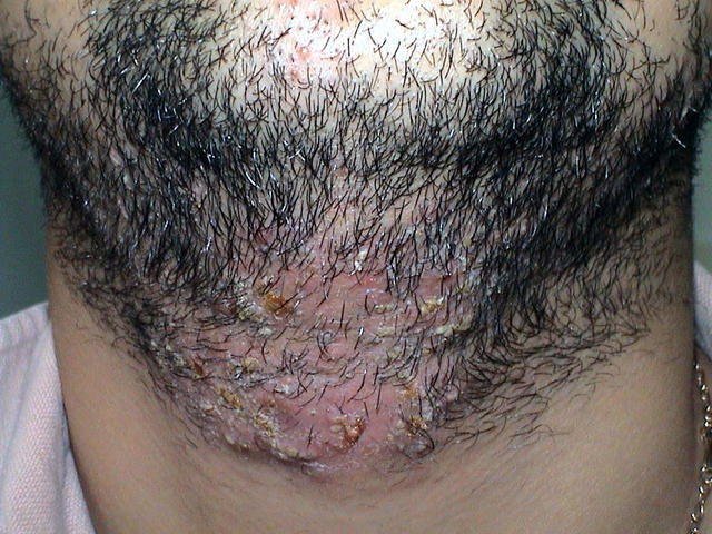 BACTERIAL INFECTIONS - Impetigo BACTERIAL INFECTIONS - Impetigo