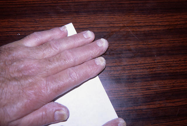 PSORIASIS - Psoriatic nails PSORIASIS - Psoriatic nails