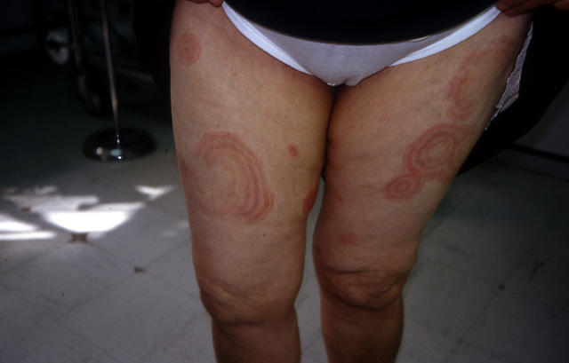 DISEASE OF THE BLOOD AND THE VESSELS – PURPURAS - Erythema gyratum repens DISEASE OF THE BLOOD AND THE VESSELS – PURPURAS - Erythema gyratum repens