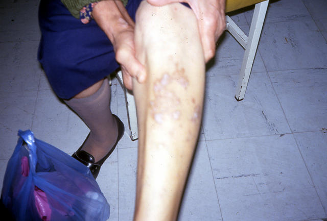 LICHEN - Lichen planus pigmentosus LICHEN - Lichen planus pigmentosus