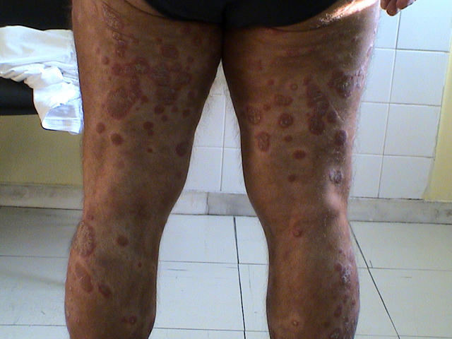 PSORIASIS - Generalized psoriasis