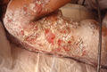 BULLOUS DISEASES - Pemphigus vulgaris