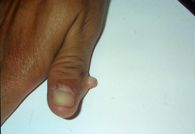 GENODERMATOSES - Auxilliary digit GENODERMATOSES - Auxilliary digit