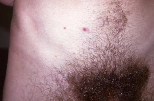 VIRAL INFECTIONS - Mollescum contagiosum VIRAL INFECTIONS - Mollescum contagiosum