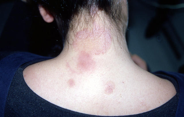 DERMATITIS - EKZEMA - Seborrheic Dermatitis