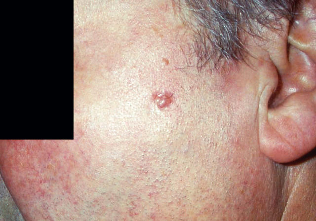 MALIGNANT LESIONS - Basal Cell Carcinoma