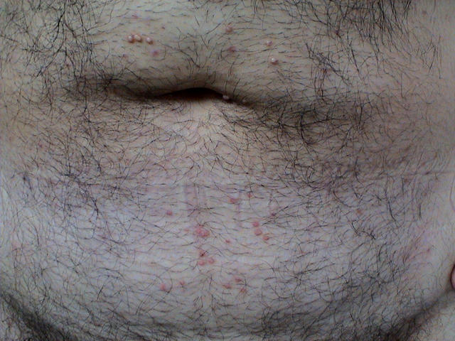 VIRAL INFECTIONS - Mollescum contagiosum VIRAL INFECTIONS - Mollescum contagiosum
