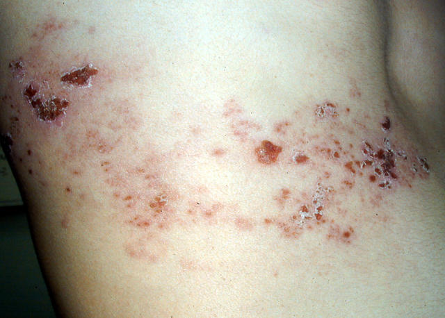 VIRAL INFECTIONS - Herpes Zoster