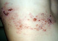 VIRAL INFECTIONS - Herpes Zoster