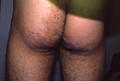 SUPERFICIAL FUNGAL INFECTIONS - Tinea infection