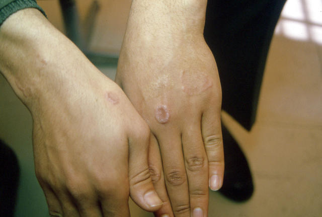 NECROBIOTIC DISORDERS - Granuloma Annulare