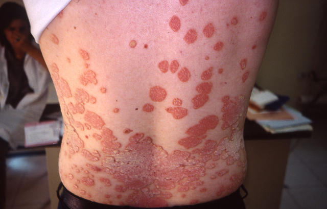 PSORIASIS - Psoriasis