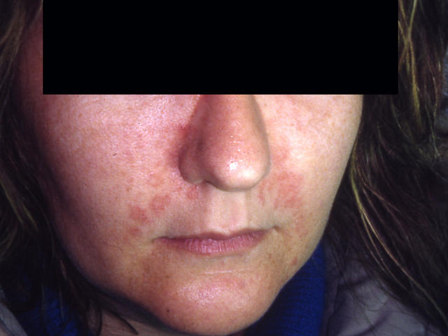 DERMATITIS - EKZEMA - Seborrheic Dermatitis