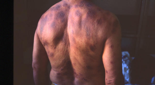 LYMPHOMAS - LYMPHOCYTIC INFILTRATIONS - Mycosis Fungoides LYMPHOMAS - LYMPHOCYTIC INFILTRATIONS - Mycosis Fungoides