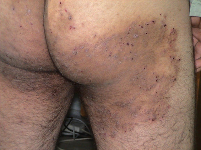 SUPERFICIAL FUNGAL INFECTIONS - Tinea infection