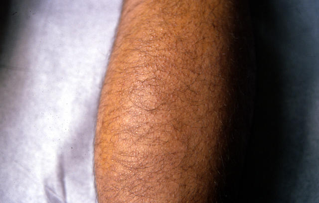 LICHEN - Lichen planus, annular LICHEN - Lichen planus, annular