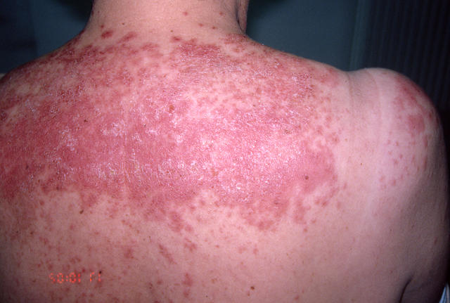 CONNECTIVE TISSUE DISORDERS - Discoid lupus erythematosus