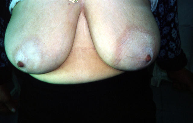 CONNECTIVE TISSUE DISORDERS - Morphea