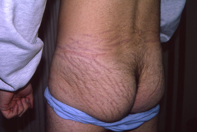 DRUG ERUPTIONS - Striae due to topical corticosteroids