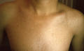 SUPERFICIAL FUNGAL INFECTIONS - Pityriasis versicolor