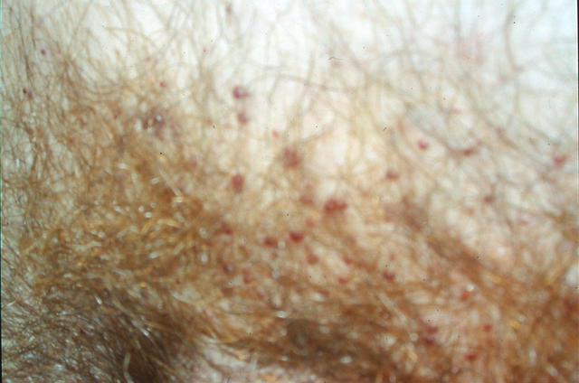 GENODERMATOSES - Fabry disease