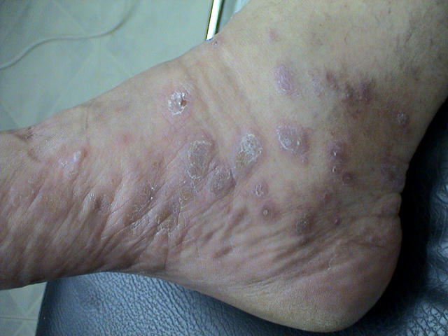 LICHEN - Hypertrophic lichen planus LICHEN - Hypertrophic lichen planus
