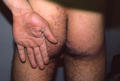 SUPERFICIAL FUNGAL INFECTIONS - Tinea infection