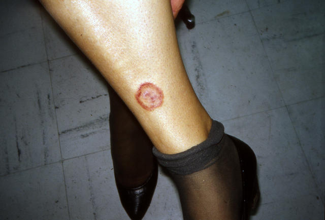 SUPERFICIAL FUNGAL INFECTIONS - Tinea SUPERFICIAL FUNGAL INFECTIONS - Tinea