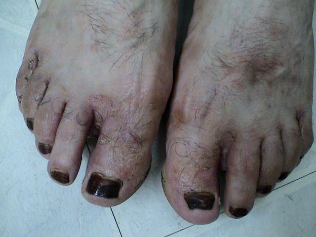 NAIL DISEASES - Nail stain NAIL DISEASES - Nail stain