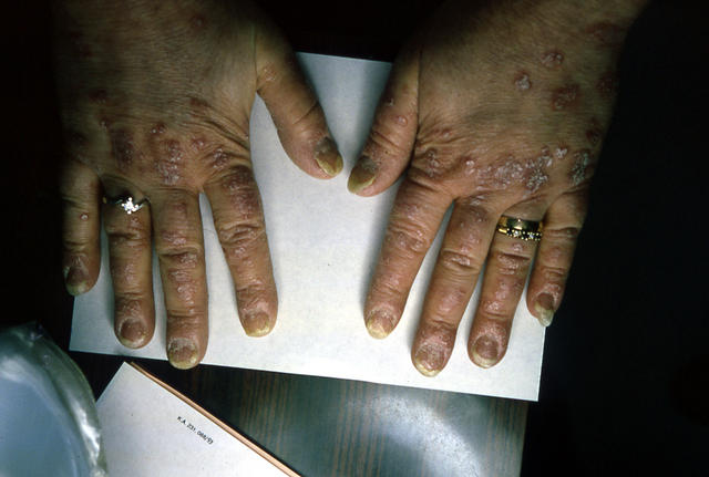 PSORIASIS - Psoriatic nails PSORIASIS - Psoriatic nails