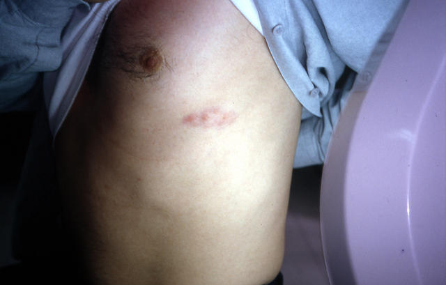 CONNECTIVE TISSUE DISORDERS - Morphea