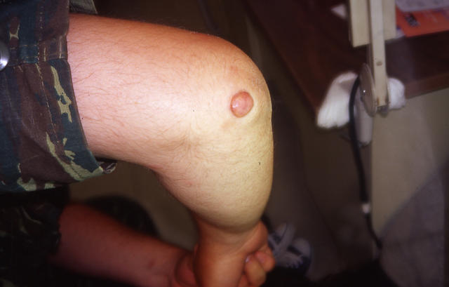 SOFT TISSUE TUMORS - Cheloid SOFT TISSUE TUMORS - Cheloid
