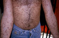 MASTOCYTOSES - Urticaria Pigmentosa