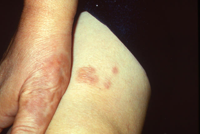 NECROBIOTIC DISORDERS - Granuloma Annulare