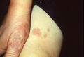 NECROBIOTIC DISORDERS - Granuloma Annulare