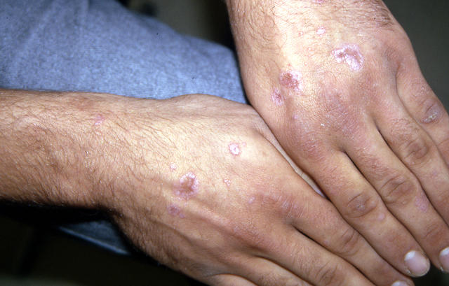 NECROBIOTIC DISORDERS - Granuloma Annulare, multiple