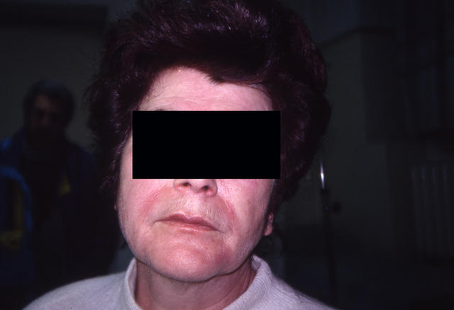 CONNECTIVE TISSUE DISORDERS - Dermatomyositis