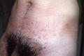 VARIOUS or of UNKNOWN ETIOLOGY DISEASES - Pityriasis rosea