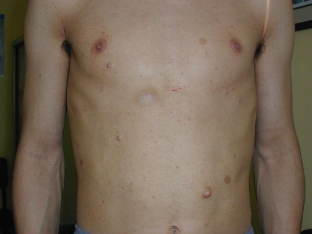 GENODERMATOSES - Neurofibromatosis (νon Recklinghausen's disease)