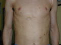 GENODERMATOSES - Neurofibromatosis (νon Recklinghausen