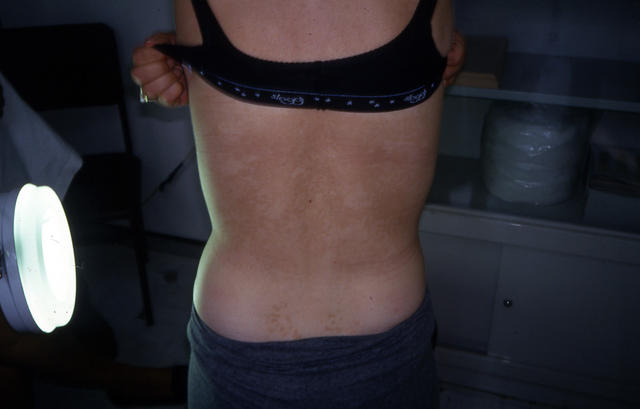 SUPERFICIAL FUNGAL INFECTIONS - Pityriasis versicolor SUPERFICIAL FUNGAL INFECTIONS - Pityriasis versicolor