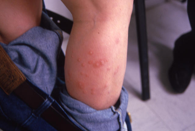 VIRAL INFECTIONS - Hand, foot and mouth disease