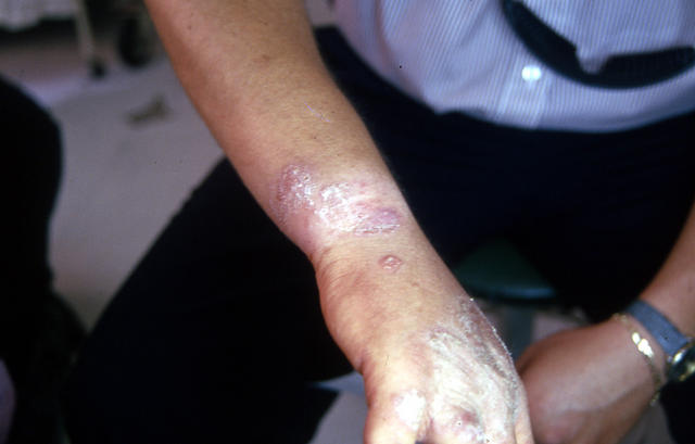 SUPERFICIAL FUNGAL INFECTIONS - Tinea infection